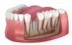 Illustrated dental implant in the lower jawbone