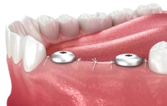 Illustrated abutment caps placed over dental implants