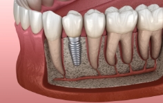 Illustrated dental implant with dental crown on top