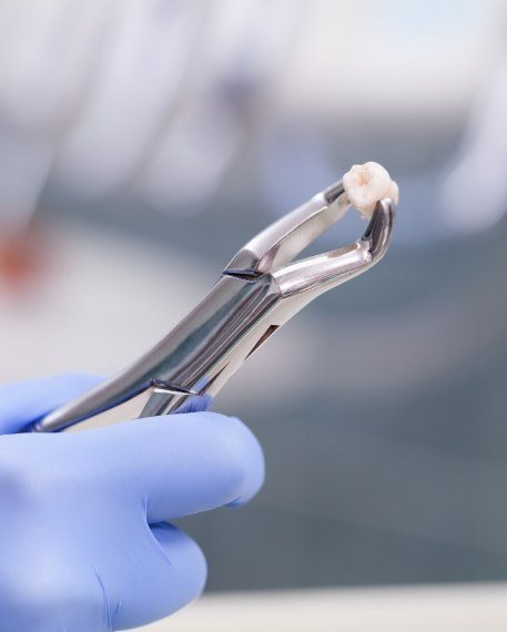 Dental forceps holding an extracted tooth