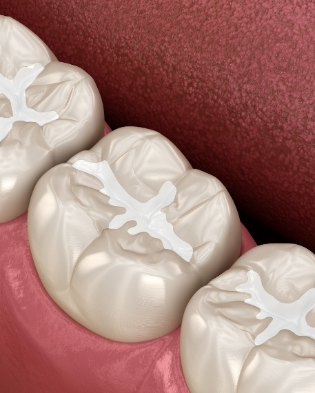 Illustrated row of teeth with white dental fillings