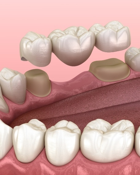Illustrated dental bridge being placed to replace a missing tooth