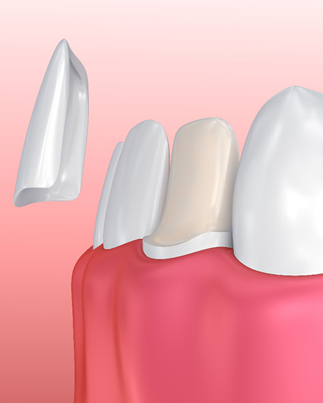 digital illustration of a veneer floating on front of a prepped tooth
