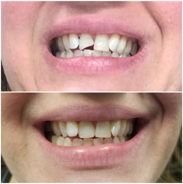 Before and after of a chipped front tooth restored with cosmetic treatment