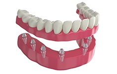 Illustration of lower arch with implants to anchor full set of dentures with white background
