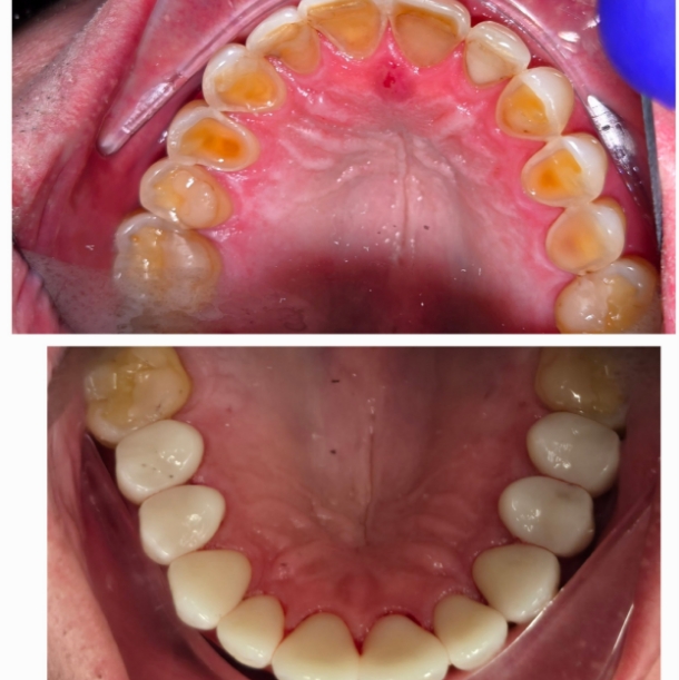 Before and after of tooth erosion treatment improving worn teeth