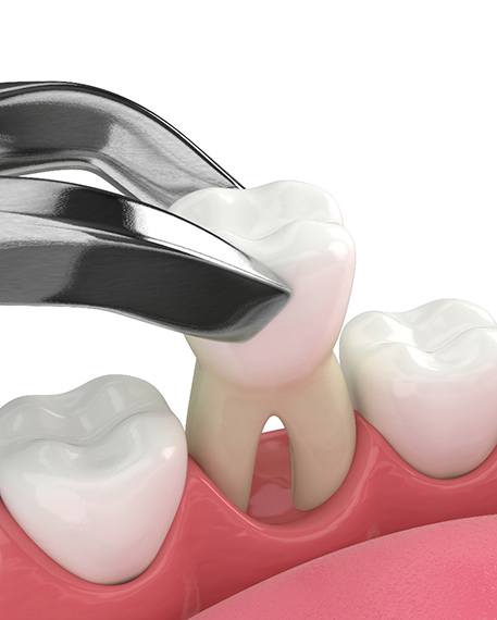 Illustration of a tooth extraction