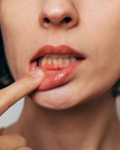 Lady shows her infected gums