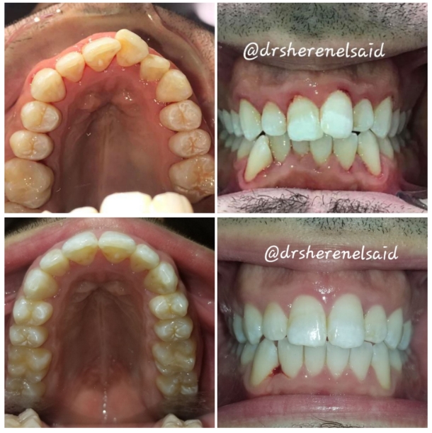 Before and after Invisalign clear aligner treatment for crowded teeth