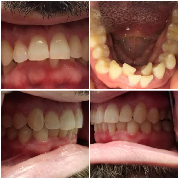 Before and after Invisalign treatment improving smile alignment