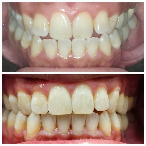 Before and after Invisalign treatment showing straighter teeth alignment