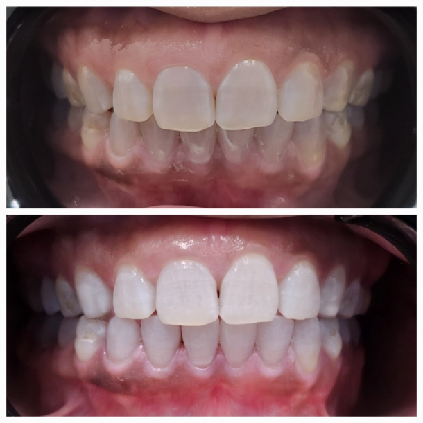 Before and after KöR teeth whitening treatment with brighter smile results