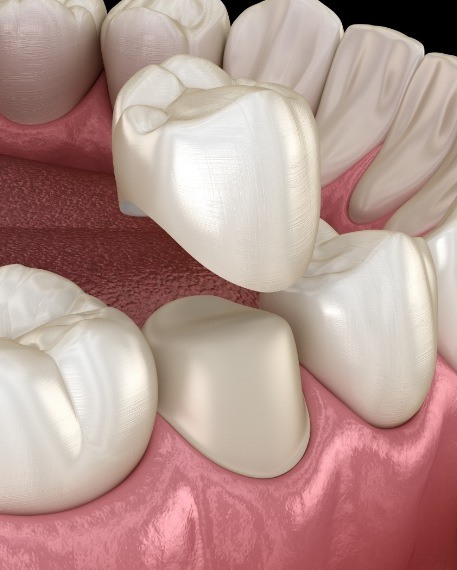 Illustrated dental crown being placed over a tooth