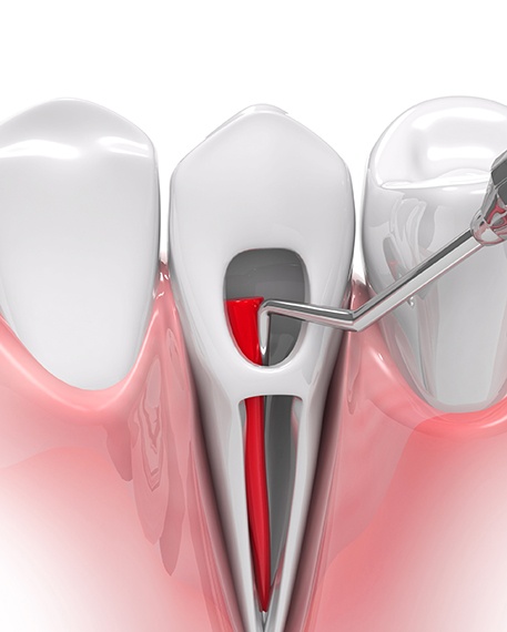 Illustration of root canal treatment in Parsippany-Troy Hills, NJ