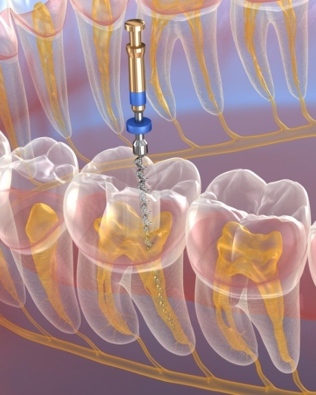 Illustrated dental instrument cleaning inside of tooth during root canal treatment