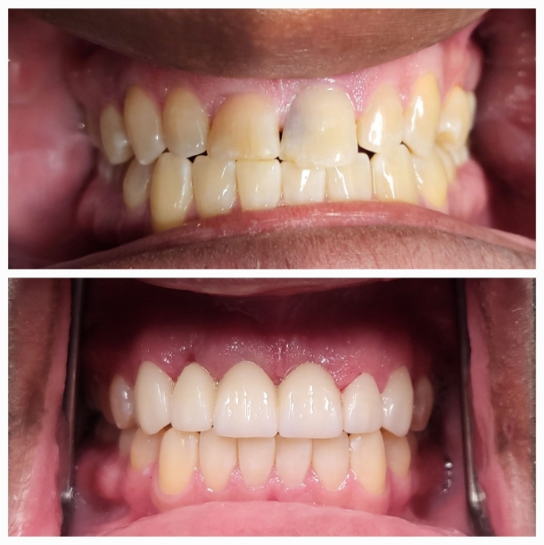 Before and after upper six-unit dental bridge restoration