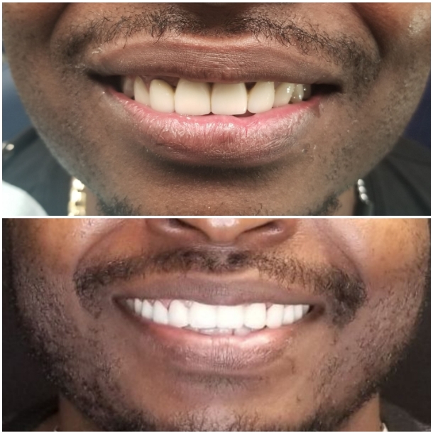 Before and after upper dental bridge and crown cosmetic restoration