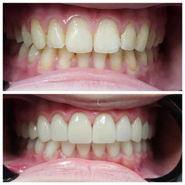 Before and after upper and lower veneer treatment enhancing smile appearance