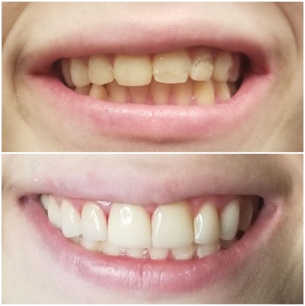 Before and after treatment with ten upper dental veneers