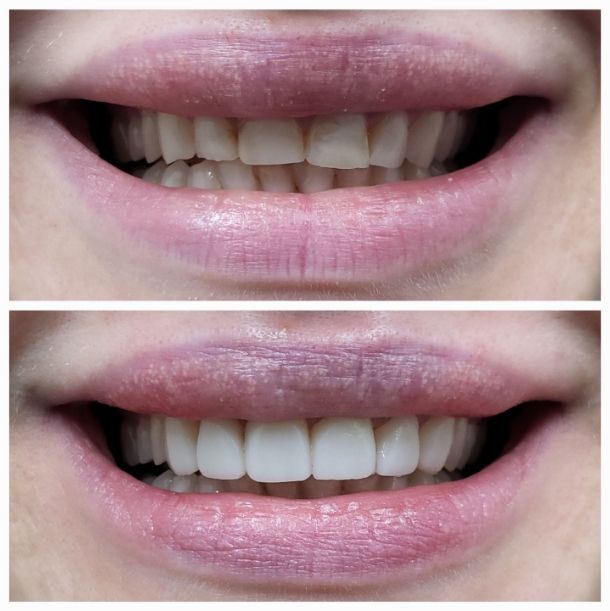 Before and after composite veneer treatment improving tooth shape and color