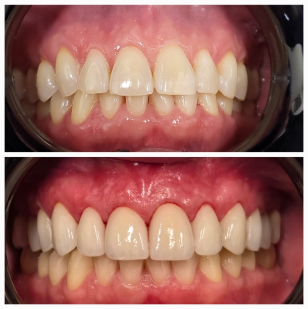 Before and after porcelain veneer smile makeover