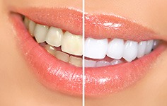 Closeup of a glossy smile that’s half whitened